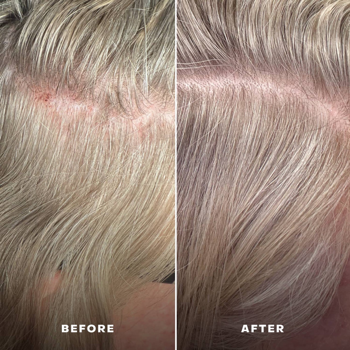 Scalp Serum | EverBoost for Dry and Brittle & Thinning Hair