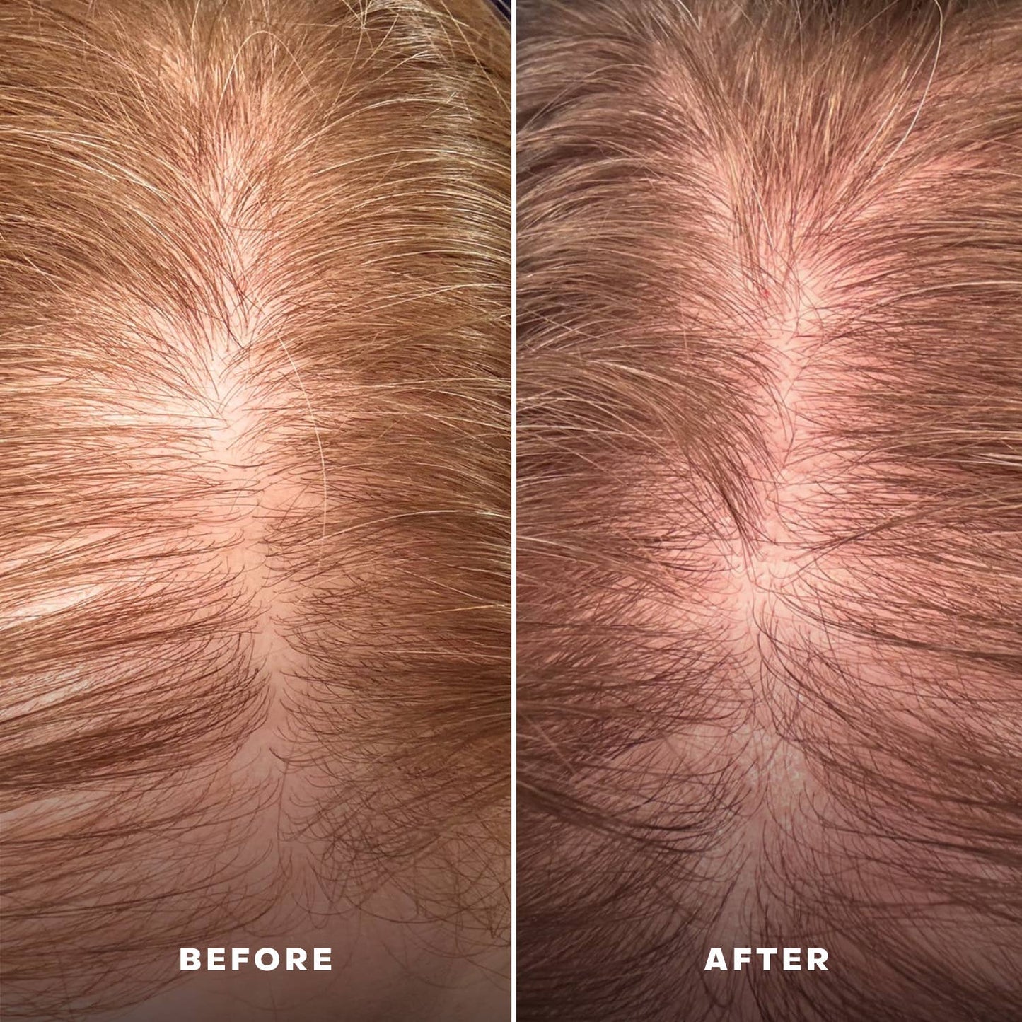 Scalp Serum | EverBoost for Dry and Brittle & Thinning Hair